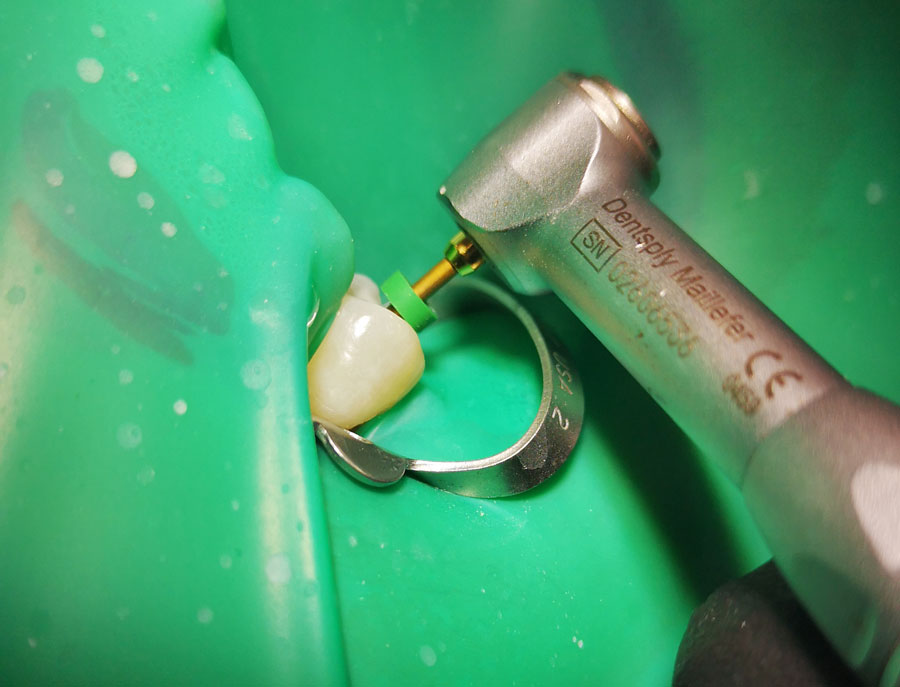 Types of endodontics Dr . Luis Fernando Lopez